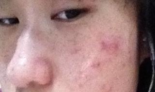 去额头痘的方法 额头长痘痘了怎么办